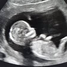 Ultrasound of fetus